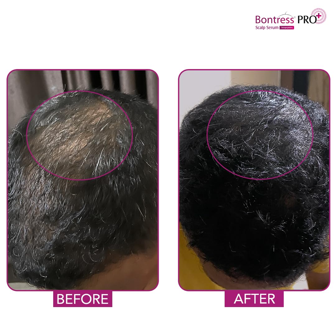 Bontress PRO+ Scalp Serum Fortified with 3% Redensyl, 3% Anagain, 4% Capixyl, 3% Procapil | Hair Serum for Hair Growth & Hair Fall 60ml