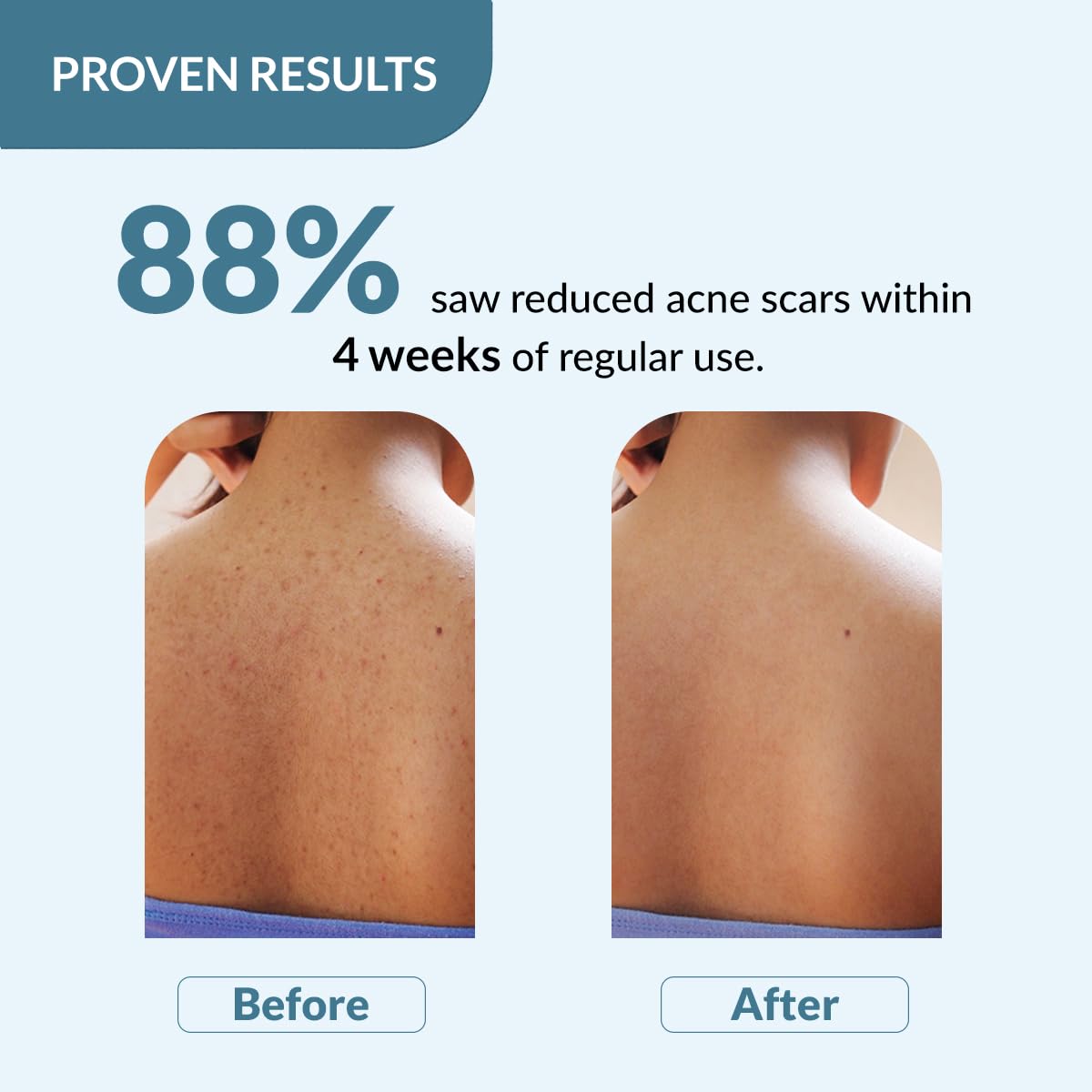 4x FIXDERMA Salyzap 2% Salicylic Acid Body Wash - 200ml each (Pack of 4)