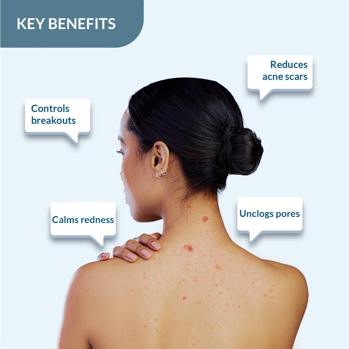 4x FIXDERMA Salyzap 2% Salicylic Acid Body Wash - 200ml each (Pack of 4)